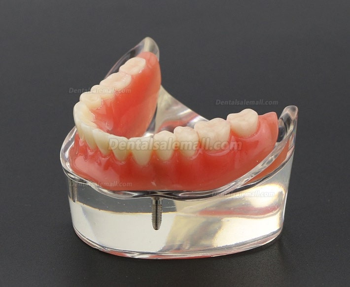 Dental Teeth Model Overdenture Inferior with 2 Implants Study Demo Model 6002 01